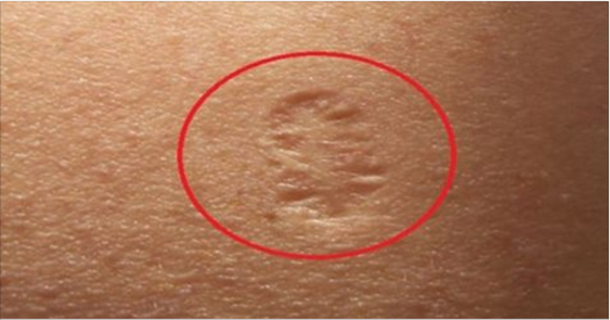 This Is The Truth About That Small Scar on the Upper Left Arm; This Is What It Truly Means - picture 2