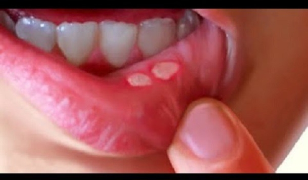 This Is What Causes Mouth Ulcers And Here's How To Get Rid Of Them Quickly - picture 2