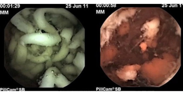 This Is What Instant Noodles Do To The Inside Of Your Stomach - picture 3