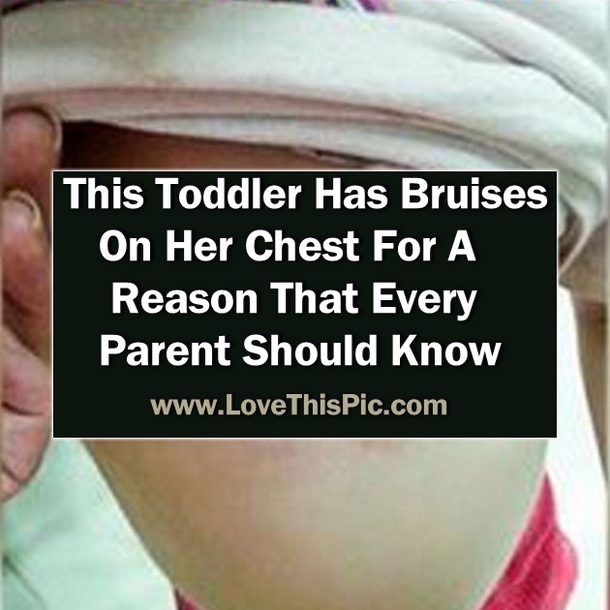 This Toddler Has Bruises On Her Chest. The Reason Why? This Is Something Every Parent Should Know...