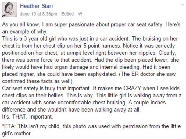 This Toddler Has Bruises On Her Chest. The Reason Why? This Is Something Every Parent Should Know... - picture 2