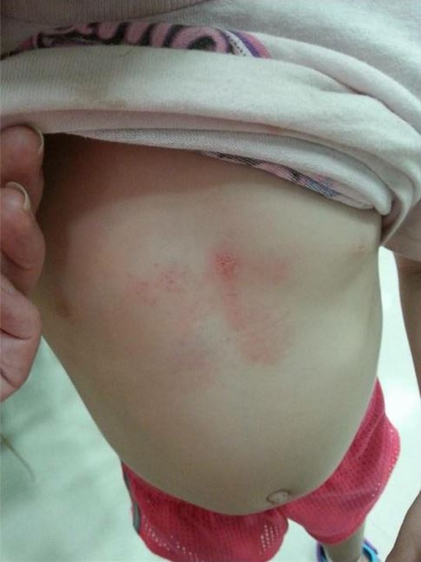 This Toddler Has Bruises On Her Chest. The Reason Why? This Is Something Every Parent Should Know... - picture 3