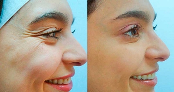 This Woman Found A Way To Quickly Get Rid Of Wrinkles With This Powerful Recipe Of Youth! - picture 2