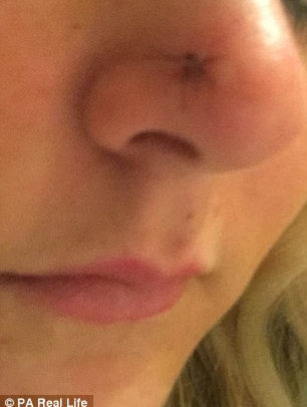 This Woman Is Warning Everyone About A Dangerous ‘Ordinary’ Habit That Caused A Hole In Her Face - picture 4