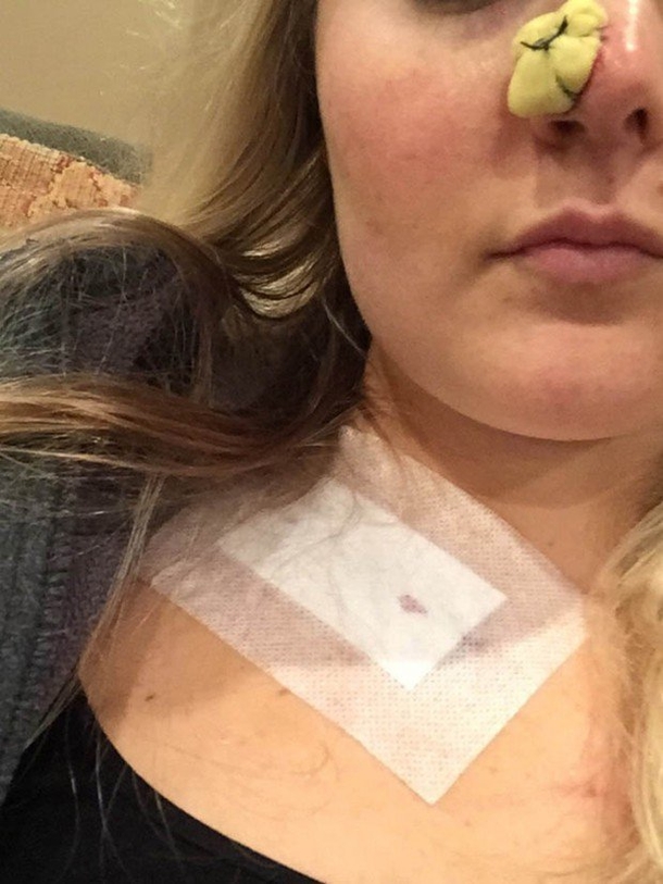 This Woman Is Warning Everyone About A Dangerous ‘Ordinary’ Habit That Caused A Hole In Her Face - picture 5