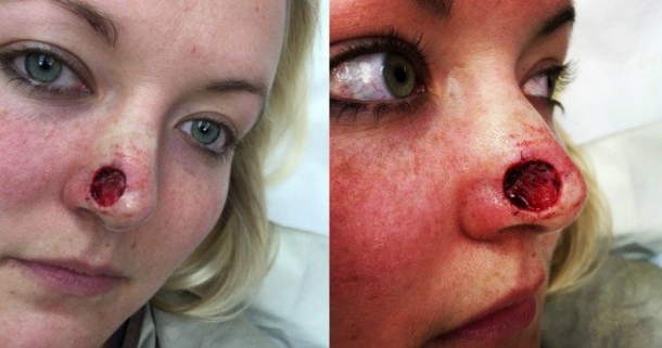 This Woman Is Warning Everyone About A Dangerous ‘Ordinary’ Habit That Caused A Hole In Her Face - picture 6