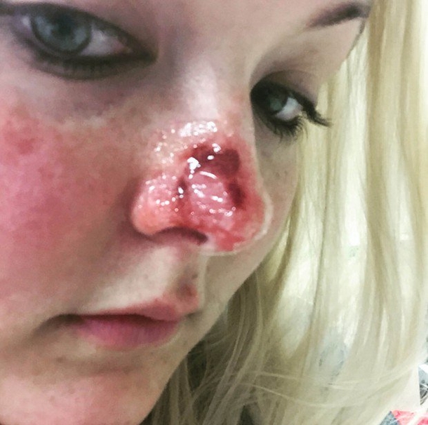 This Woman Is Warning Everyone About A Dangerous ‘Ordinary’ Habit That Caused A Hole In Her Face - picture 7
