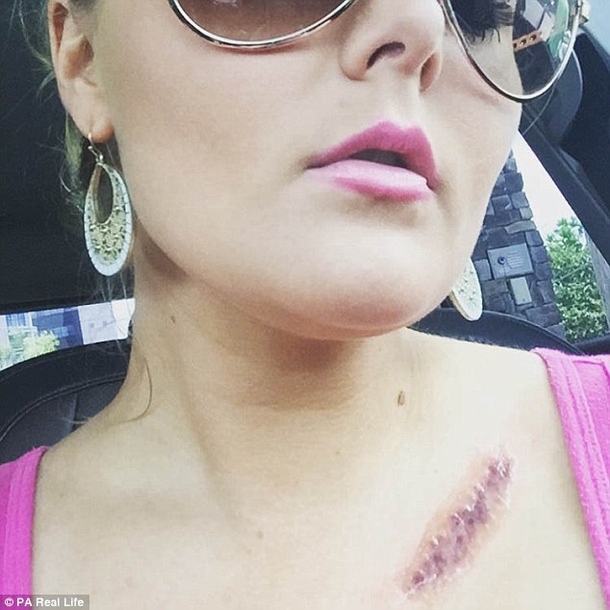 This Woman Is Warning Everyone About A Dangerous ‘Ordinary’ Habit That Caused A Hole In Her Face - picture 8