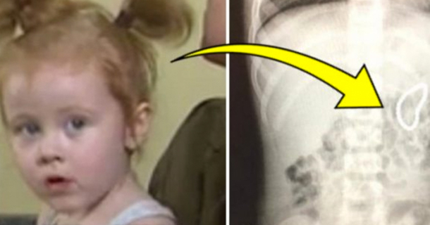 Toddler Girl Complains Of Extreme Stomach Pain, Parents Stunned When X-Ray Shows What’s Inside Her - picture 2