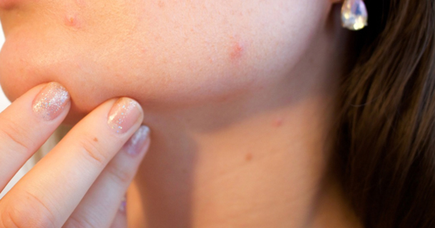 Top 10 Reasons You Should Apply Tea Tree Oil To Your Skin Right Now - picture 2