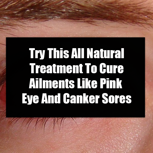 Try This All Natural Treatment To Cure Ailments Like Pink Eye And Canker Sores