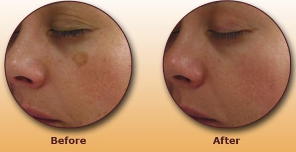 Try This Simple Trick to Get Rid of Brown Spots on Face & Skin - picture 2