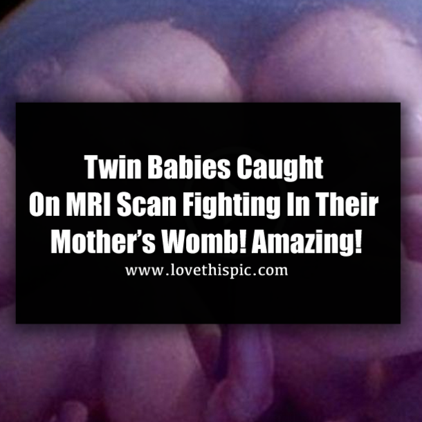 Twin Babies Caught On MRI Scan Fighting In Their Mother’s Womb! Amazing!