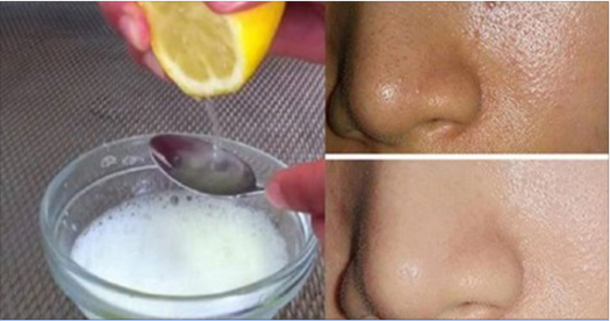Use These 2 Simple Ingredients And Your Pores Will Disappear Forever & Your Face Will Be Extremely Clear! - picture 2