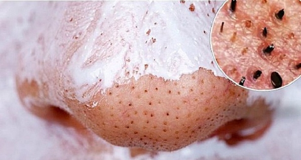 USE THIS SIMPLE AND EFFECTIVE TRICK AND GET RID OF BLACKHEADS - picture 2