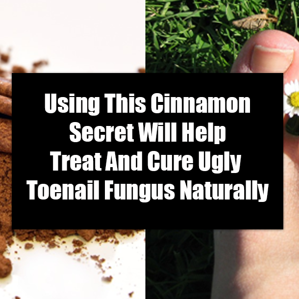 Using This Cinnamon Secret Will Help Treat And Cure Ugly Toenail Fungus Naturally