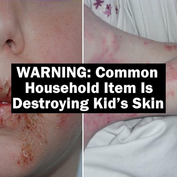 WARNING: Common Household Item Is Destroying Kid’s Skin