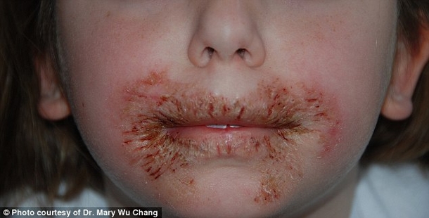 WARNING: Common Household Item Is Destroying Kid’s Skin - picture 2