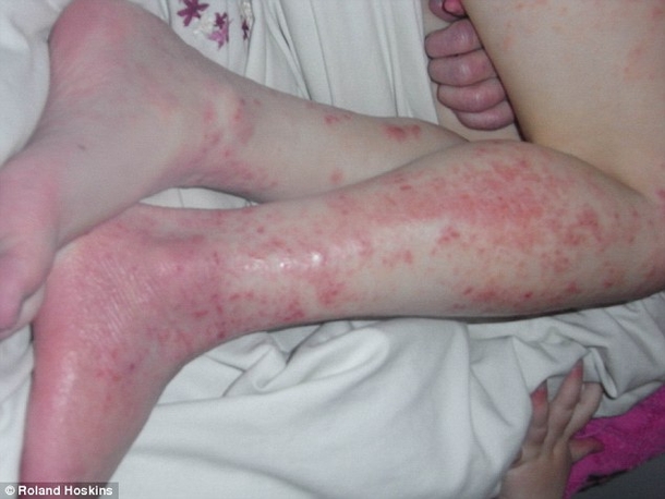 WARNING: Common Household Item Is Destroying Kid’s Skin - picture 3