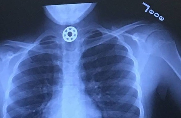 WARNING If Your Kids Have ‘Fidget Spinners’ Throw Them Out NOW. THIS Shocking New Danger Just Discovered - picture 5