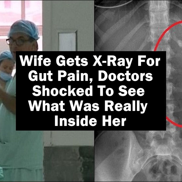 Wife Gets X-Ray For Gut Pain, Doctor Shocked To See What Was Really Inside Her