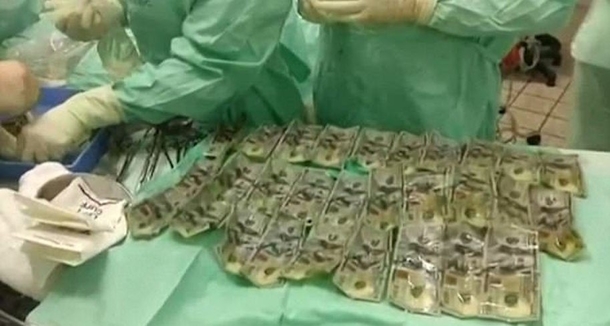 Wife Gets X-Ray For Gut Pain, Doctor Shocked To See What Was Really Inside Her - picture 3