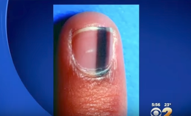 Woman Goes To Nail Salon; When They Notice Dark Line On Her Nails, They Warn Her Of Dangerous Meaning - picture 2