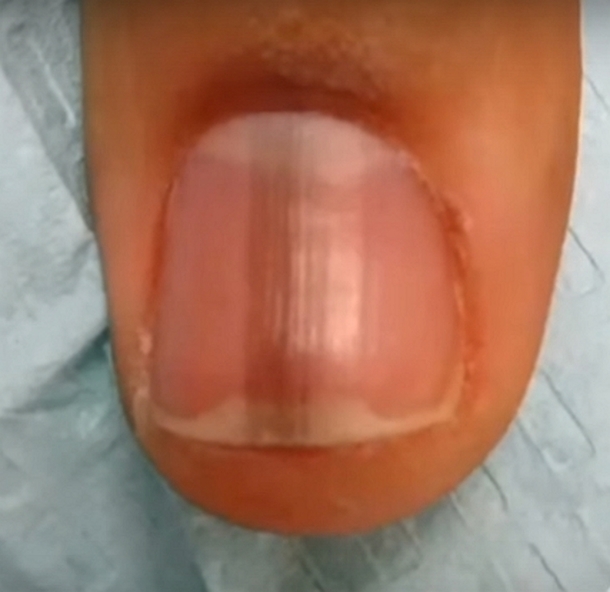Woman Goes To Nail Salon; When They Notice Dark Line On Her Nails, They Warn Her Of Dangerous Meaning - picture 5