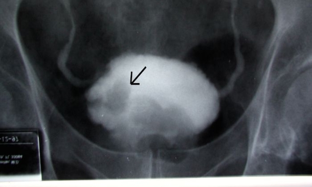 Woman Issues Important Health Warning To Others After Urinating Worms For 3 Months - picture 2