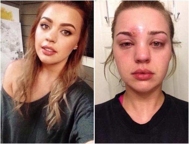 Woman Pops Pimple, Urges Others To Beware After She Almost Dies - picture 3