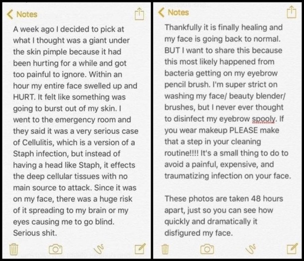 Woman Pops Pimple, Urges Others To Beware After She Almost Dies - picture 4