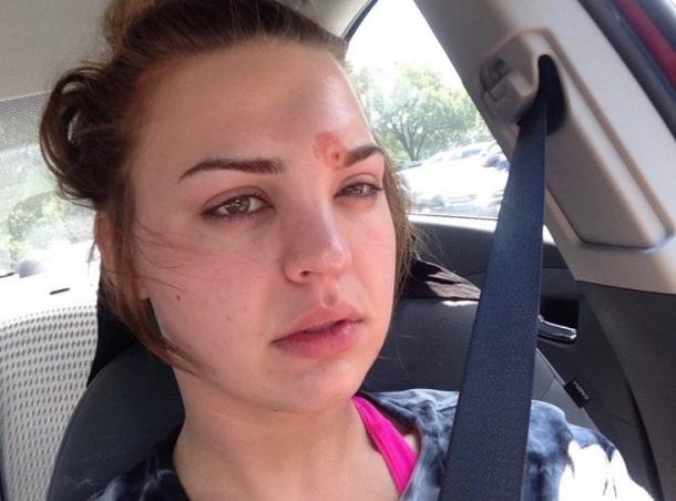 Woman Pops Pimple, Urges Others To Beware After She Almost Dies - picture 6