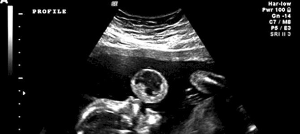 Woman Thinks Baby Is Blowing A Bubble In Ultrasound, Then Doctors Reveal What It Really Is - picture 2