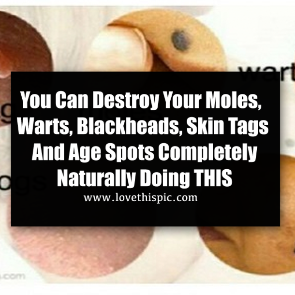 You Can Destroy Your Moles, Warts, Blackheads, Skin Tags And Age Spots Completely Naturally Doing THIS