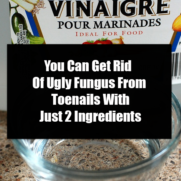 You Can Get Rid Of Ugly Fungus From Toenails With Just 2 Ingredients