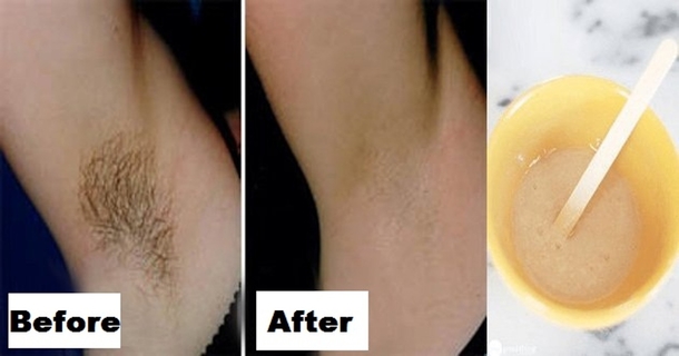 You Only Need 2 Ingredients And 2 Minutes To Get Rid of Underarm Hair Forever - picture 2