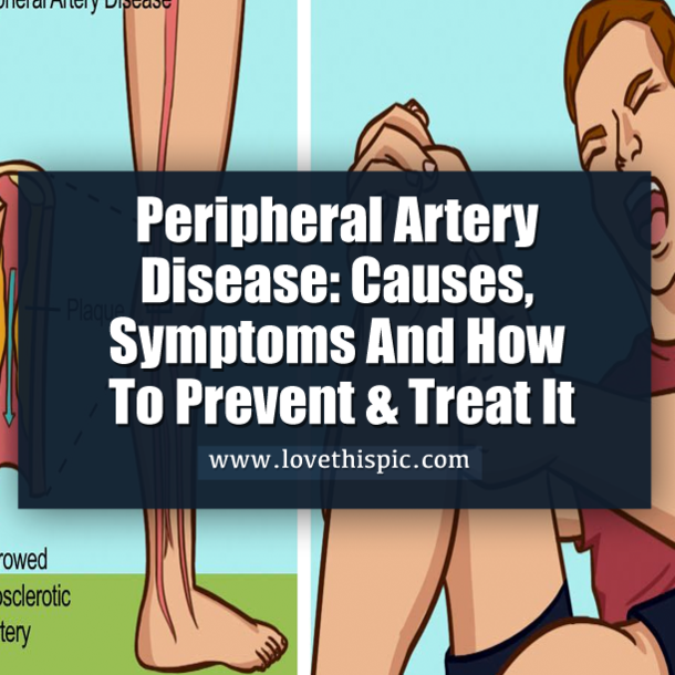 You Should Know The Symptoms Of Bad Circulation & Blocked arteries. Here's How To Prevent & Treat It.
