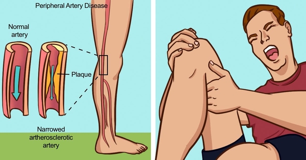 You Should Know The Symptoms Of Bad Circulation & Blocked arteries. Here's How To Prevent & Treat It. - picture 2