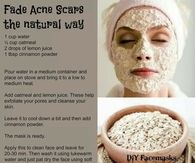 naturally fade acne scars