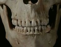 Skeleton grinding teetn