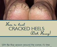 Cracked Heels 