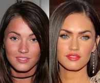 before and after surgery- Magen Fox (love her face)