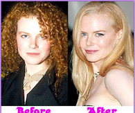 before and after surgery- Nicole Kidman facial surgery