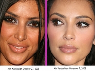 before and after- kim kardashian (surgery or not)
